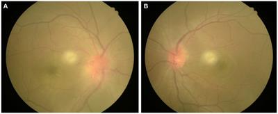 Case report: A rare case of bilateral Leber’s idiopathic stellate neuroretinitis